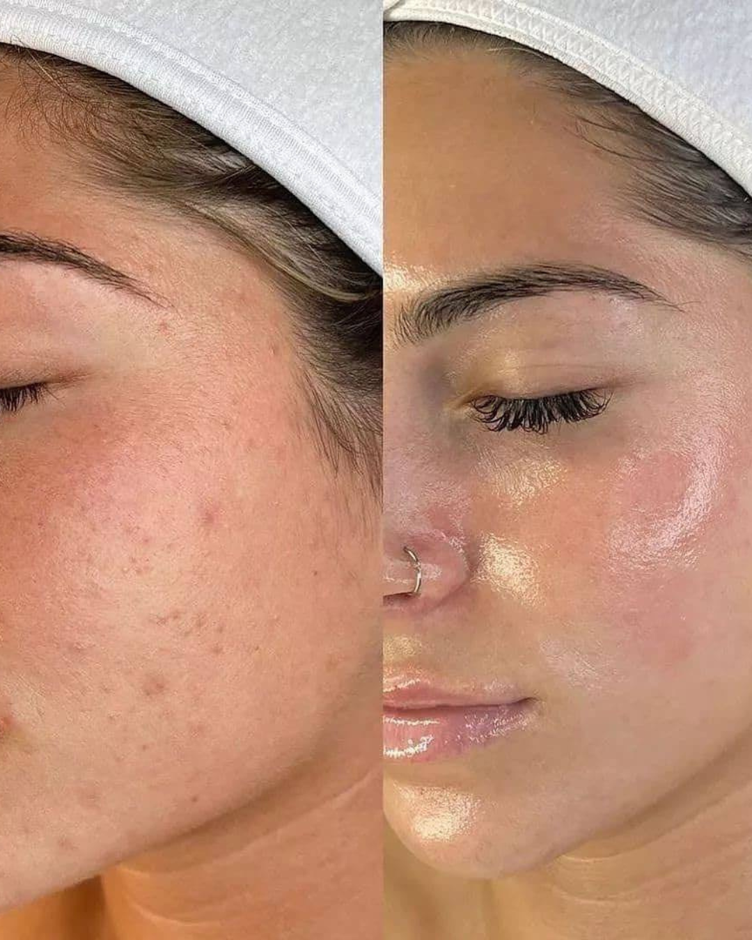 Before and After PDRN Microneedling in Calgary