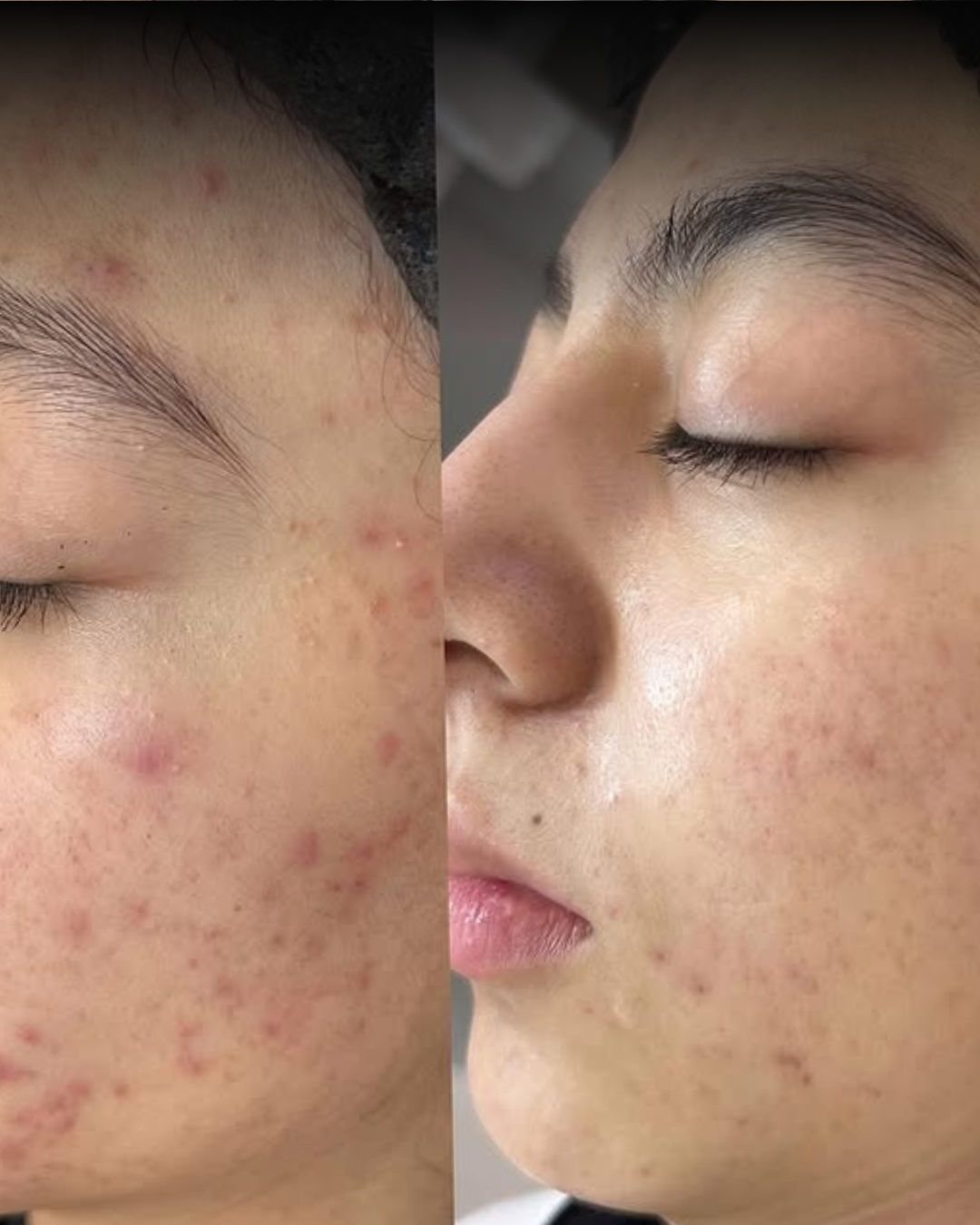 Before and After PDRN Microneedling in Calgary