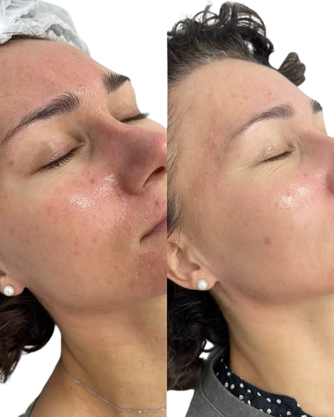 Before and After Exosome Microneedling in Calgary