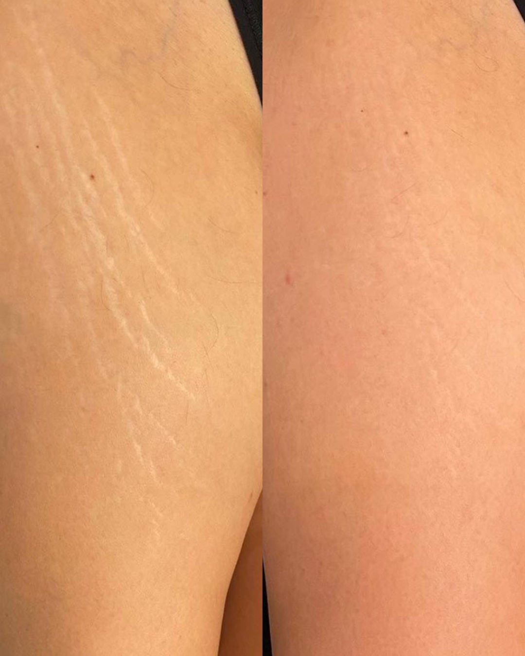 Before and After Stretch Mark Removal in Calgary