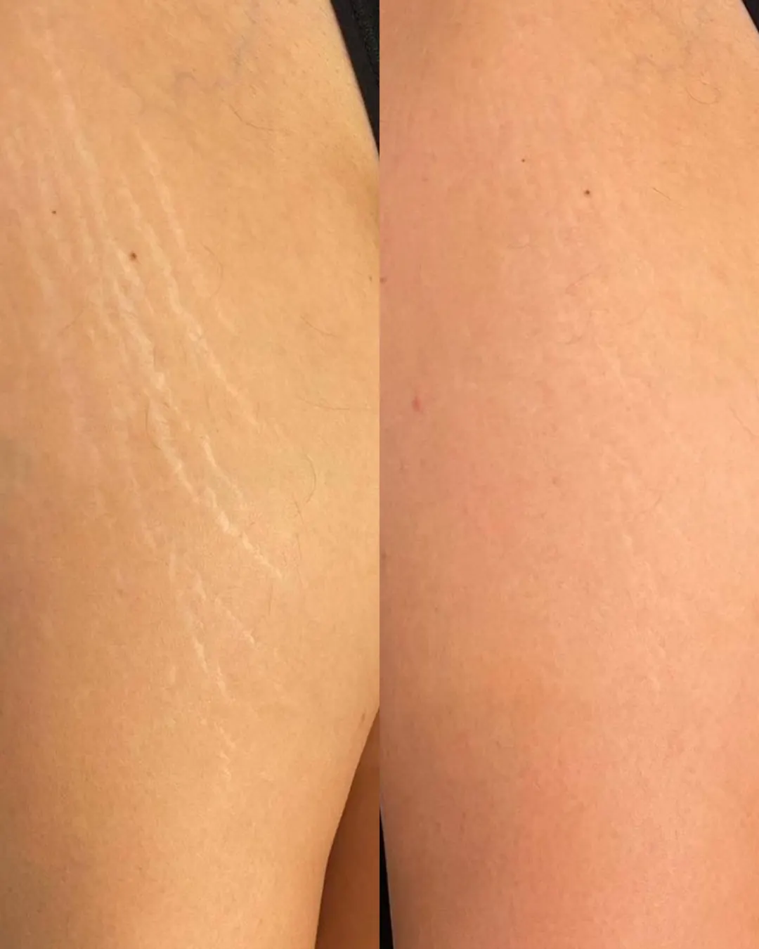 Before and After Stretch Mark Removal in Calgary