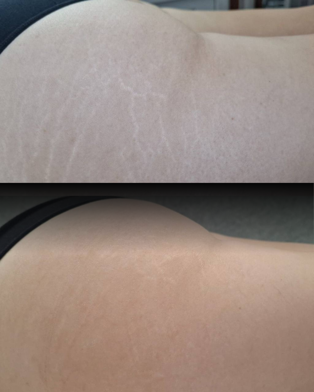 Before and After Stretch Mark Removal in Calgary