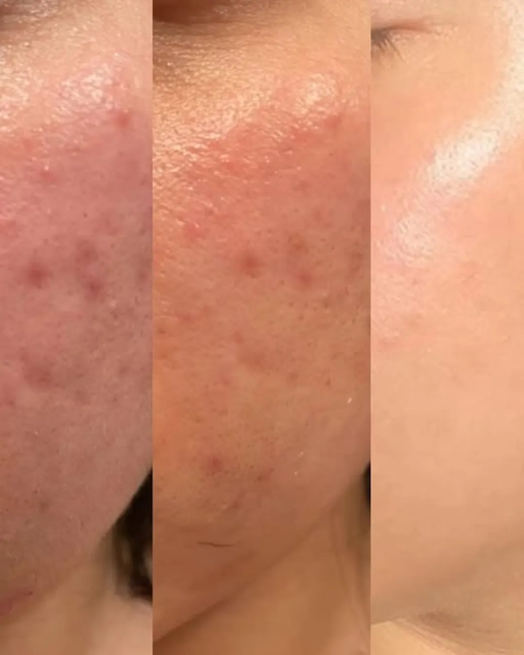 Before and After PDRN plus Booster Microneedling in Calgary